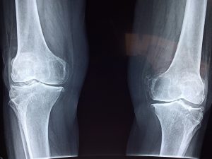 bone disorders osteoporosis 